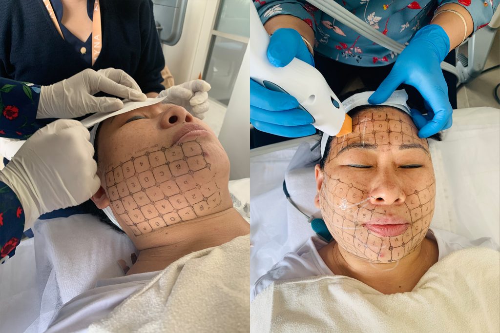 facial treatment