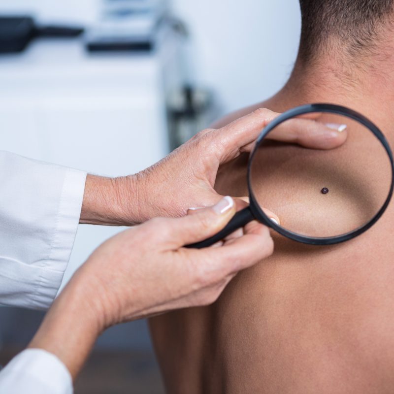 Mole treatment at Aayna clinic