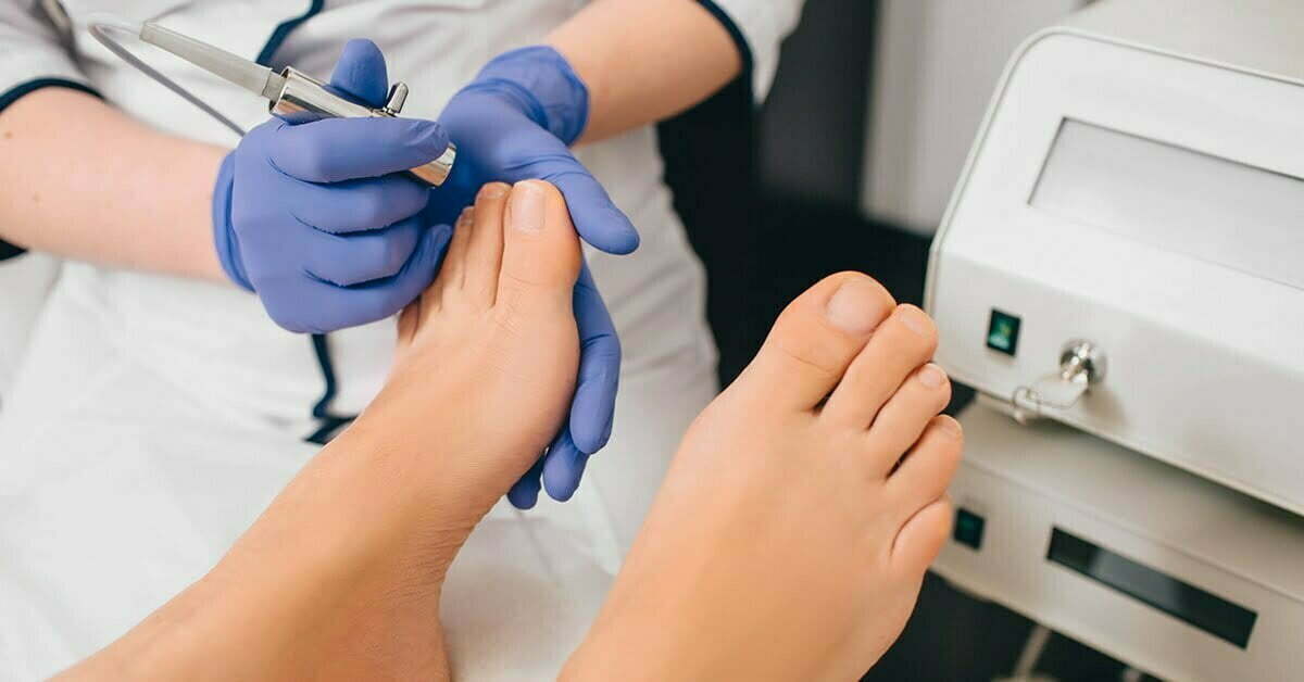Treat Foot Corns without any Surgery!