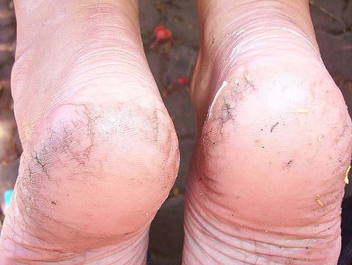 foot corn treatment