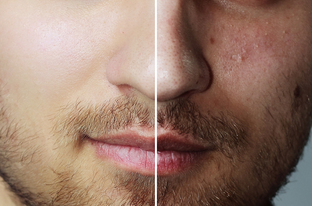 Laser Treatment for Acne Scars In Delhi