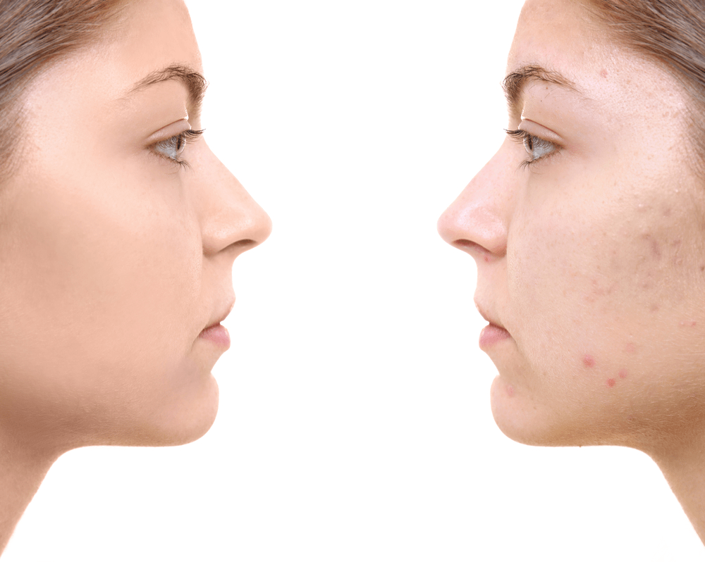 acne scar removal cost