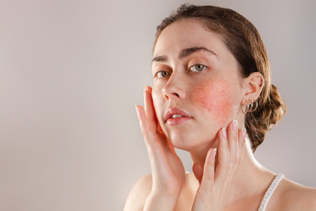 What causes Rosacea
