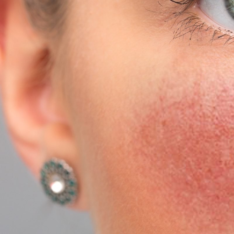 Rosacea Symptoms