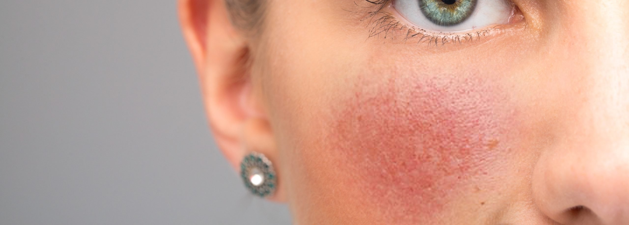 Caution! The Reason Behind your Flushed Cheeks May be Rosacea