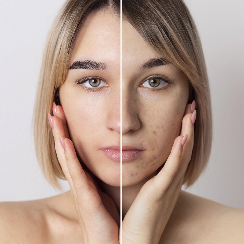 Skin Pigmentation Treatment in delhi