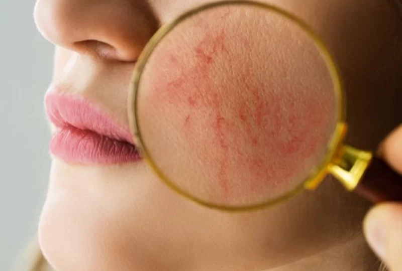 Your Flushed Face May Turn into Rosacea