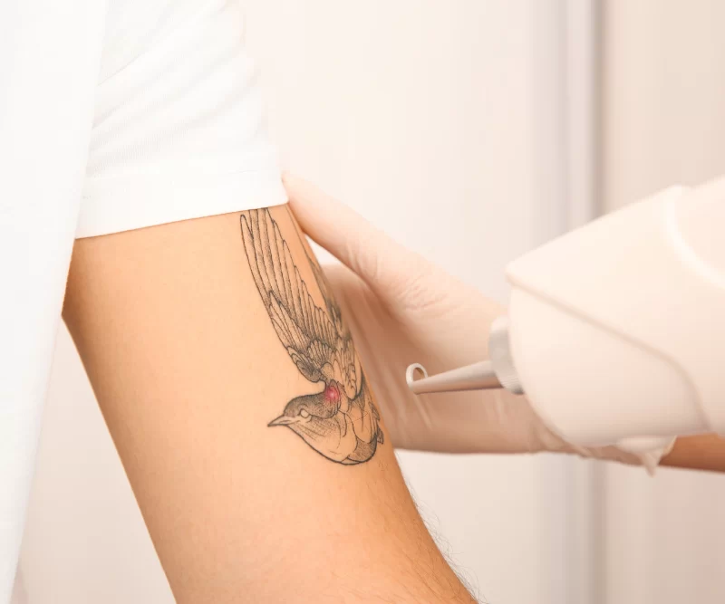 Tattoo Removal