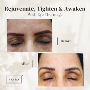 Thermage, Eye Thermage