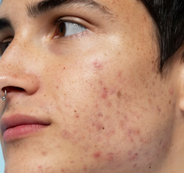 Acne Causes