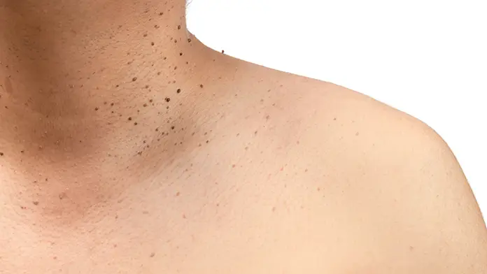 Complete Guide to Remove Black Spots on Back and Neck