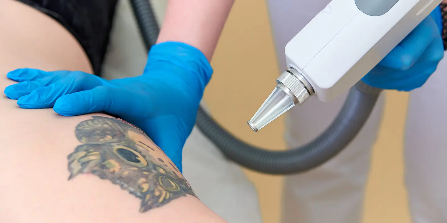Laser Tattoo Removal – How Does it Work?