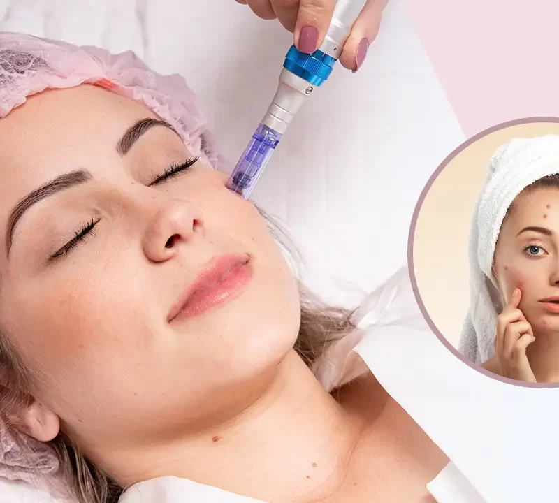Dermapen Microneedling Treatment