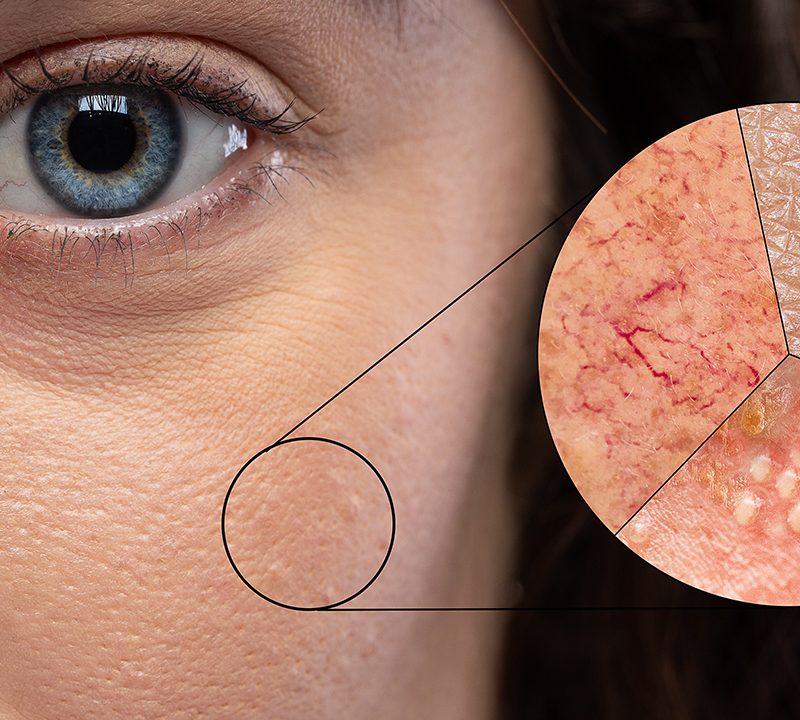 Open Pores Treatment / Aayna Clinic