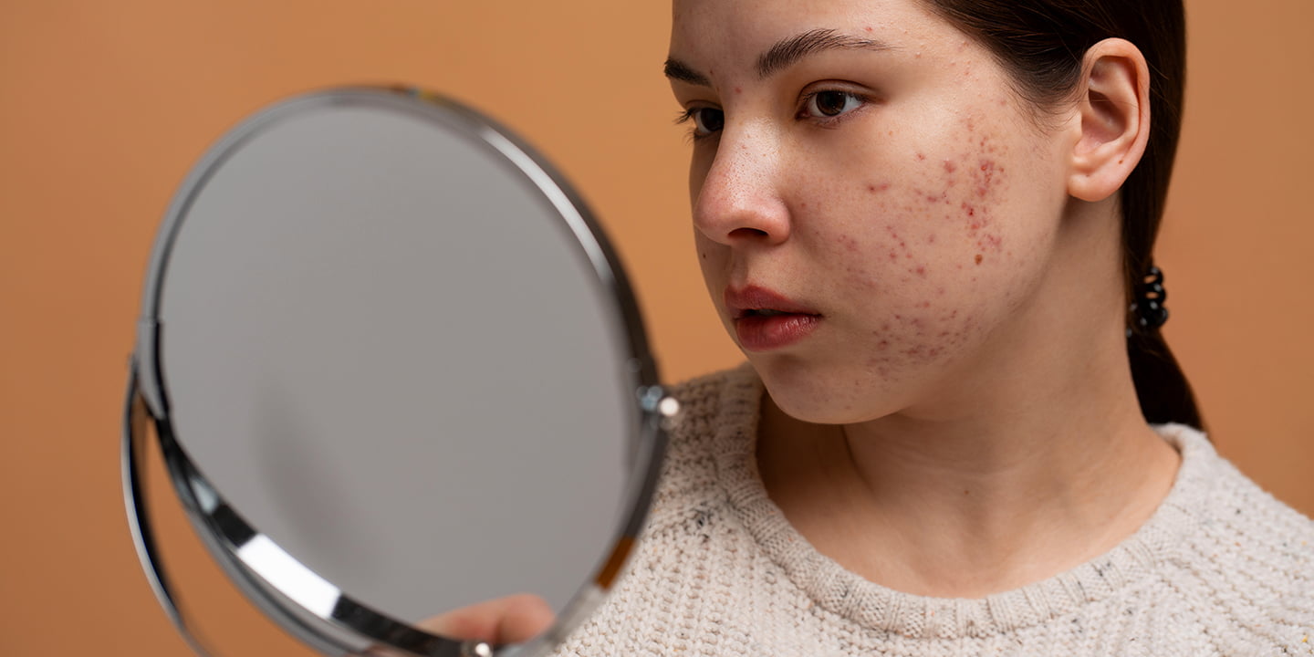 8 Best Ways to Get Rid of Dark Spots on Face