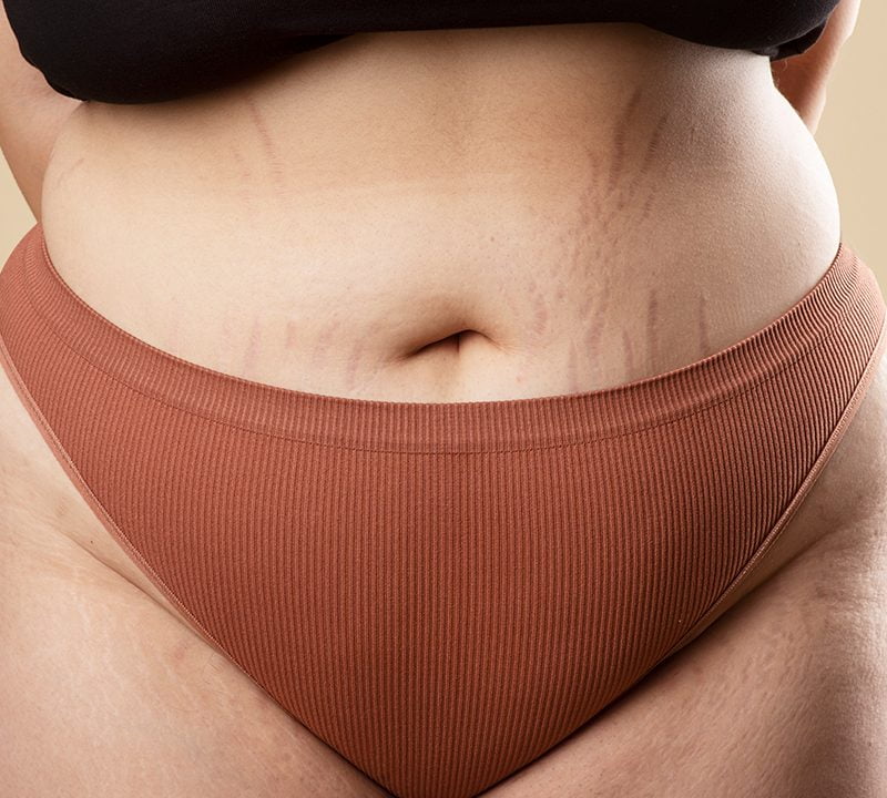 Stretch Marks Treatment / Aayna Clinic