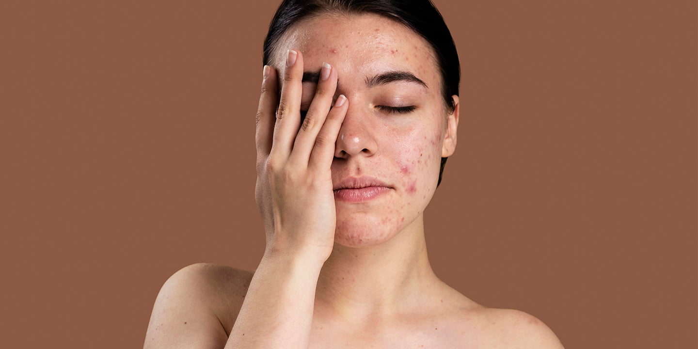 How to Prevent Acne: 8 Tips to Reduce Pimples