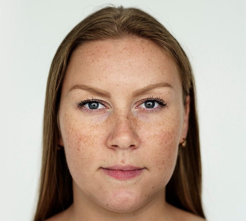 Hyperpigmentation Treatment Options / Aayna Clinic