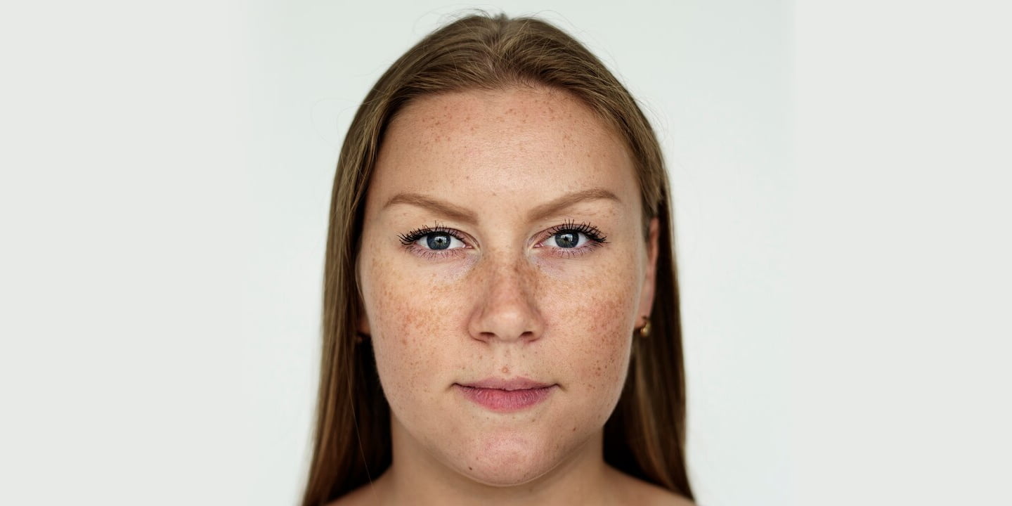 Hyperpigmentation: 8 Best Treatment Options
