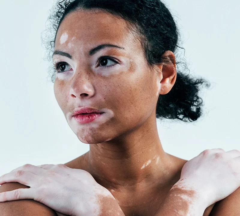 Vitiligo Treatment at AAYNA Clinic