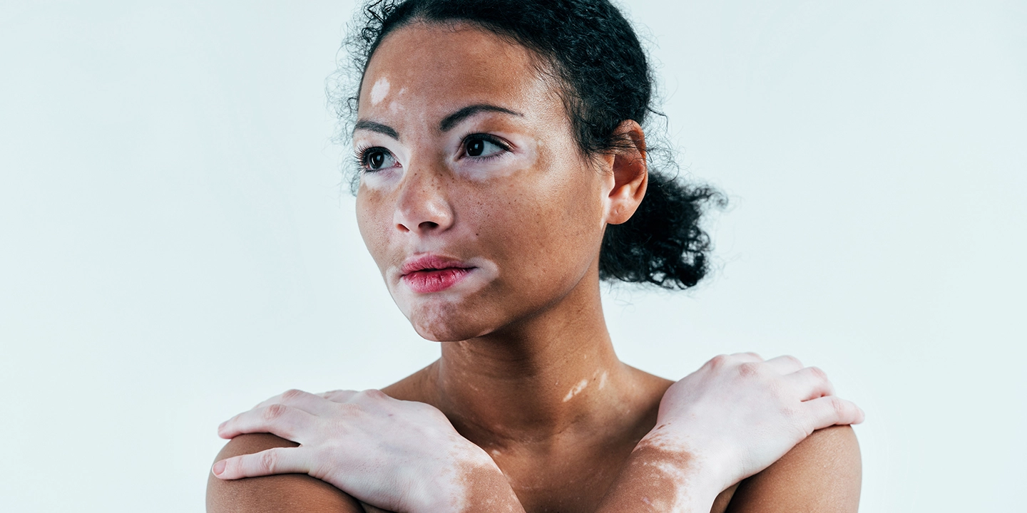 Vitiligo: Types, Symptoms, Causes & Treatment