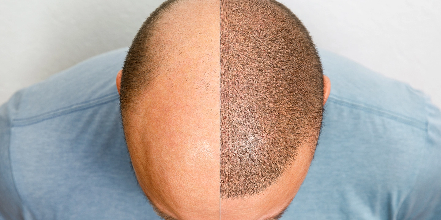 Scalp Micropigmentation: Benefits, Costs and Results