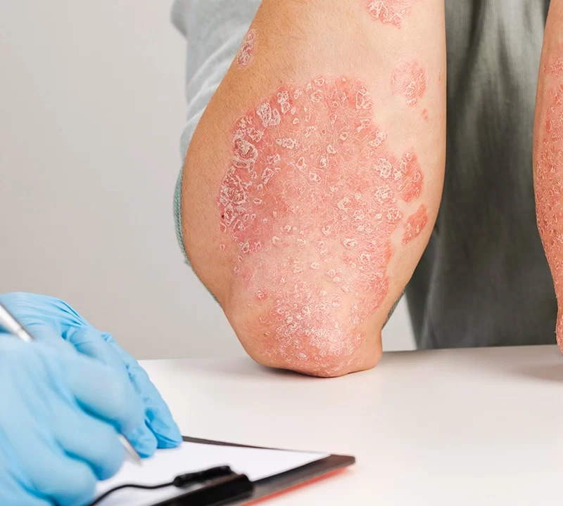 Psoriasis Signs and Symptoms