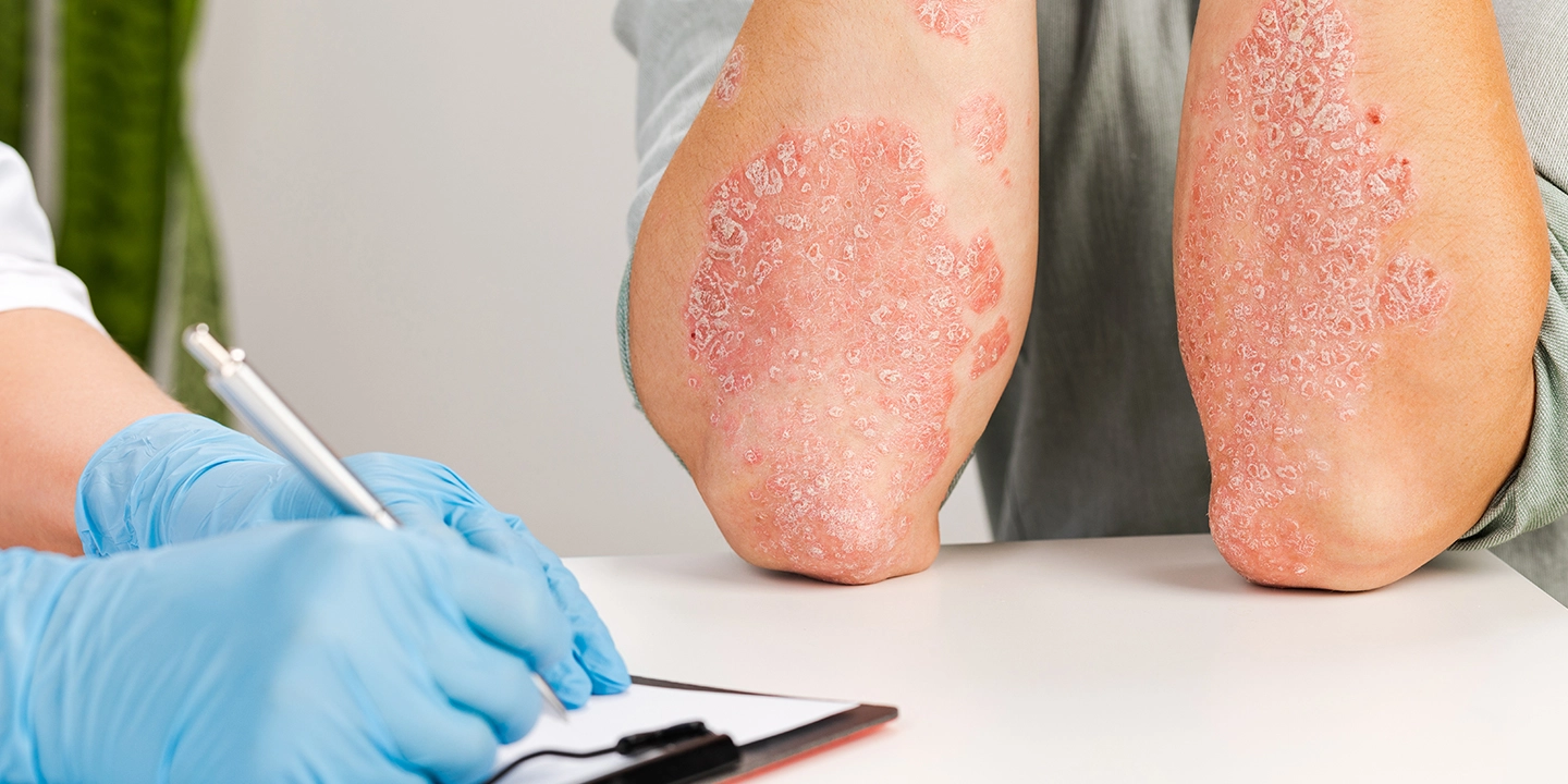 Psoriasis Symptoms: 5 Signs & Symptoms of Psoriasis