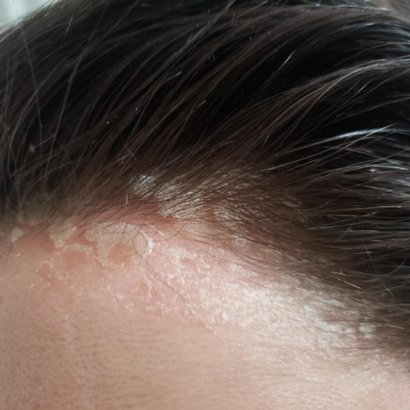 sunburn, scalp sunburn, hairline sunburn