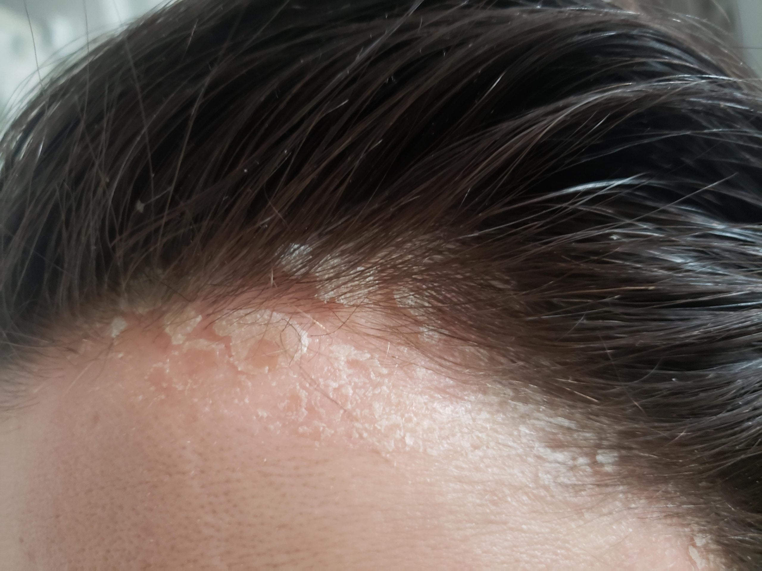 5 Solutions for Soothing a Sunburn on Your Scalp and Hairline