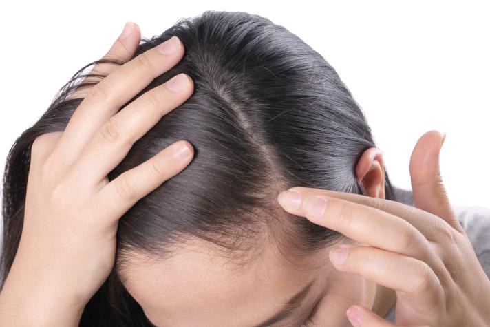 Understanding & Treating Hairline Acne: Meaning & Solutions from Derms