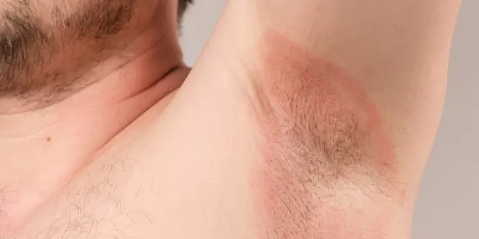 Dermatologists Reveals 5 Triggers Behind Armpit Rashes
