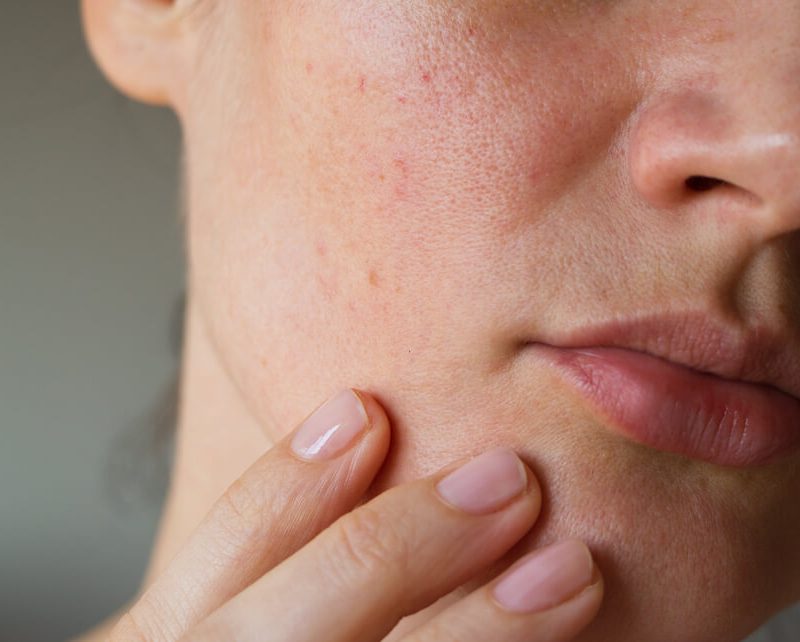 Blackheads, Blackhead, Causes, Symptoms, Areas, Treatments
