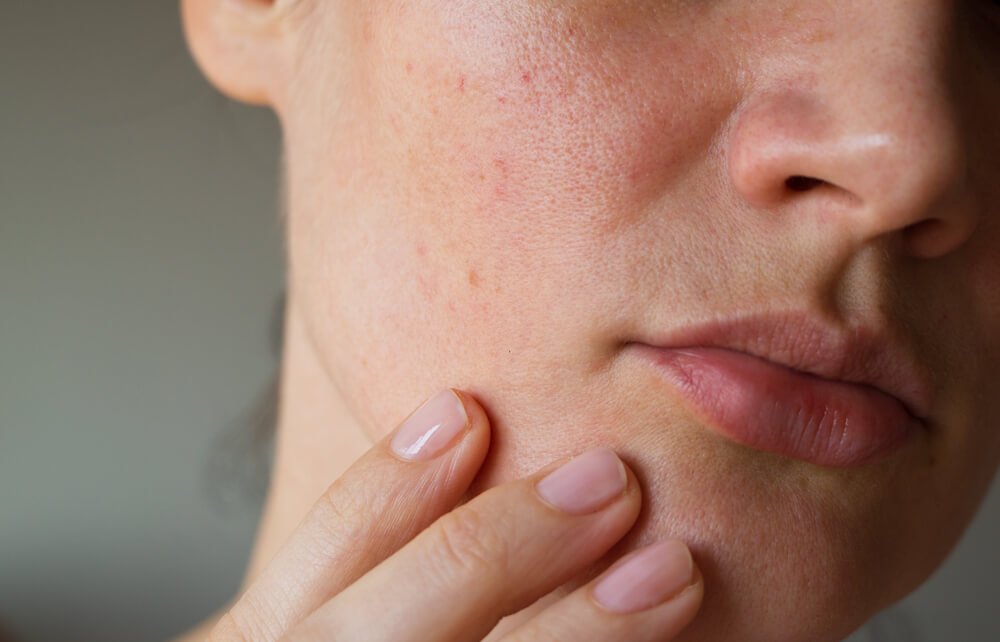 Unlock the Scoop on Blackhead Removal: Derms Reveal Safe Techniques!