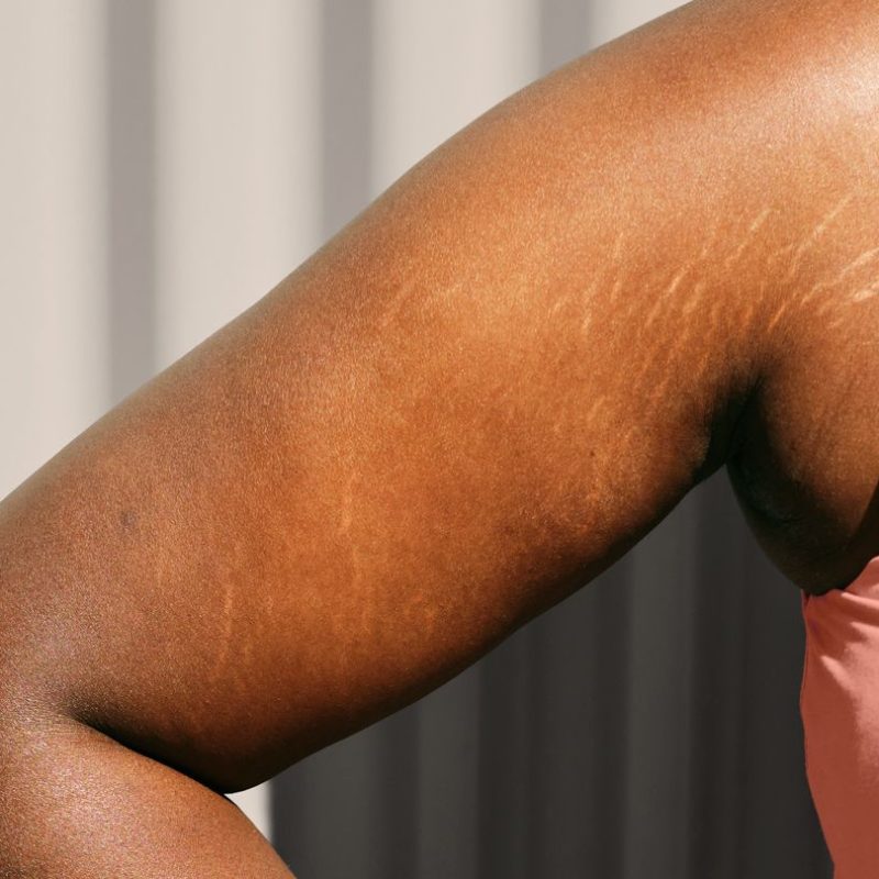 Stretch marks, marks