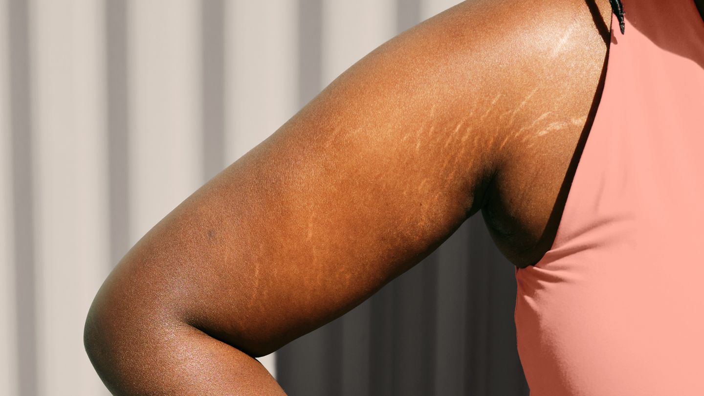 Top 5 Derms-Recommended Solutions for Stretch Marks