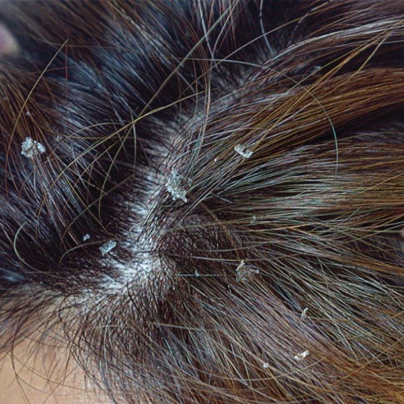 Dry Scalp