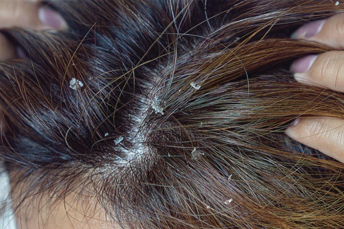 Dermatologist Tips: Causes, Treatment, and Prevention of Dry Scalp