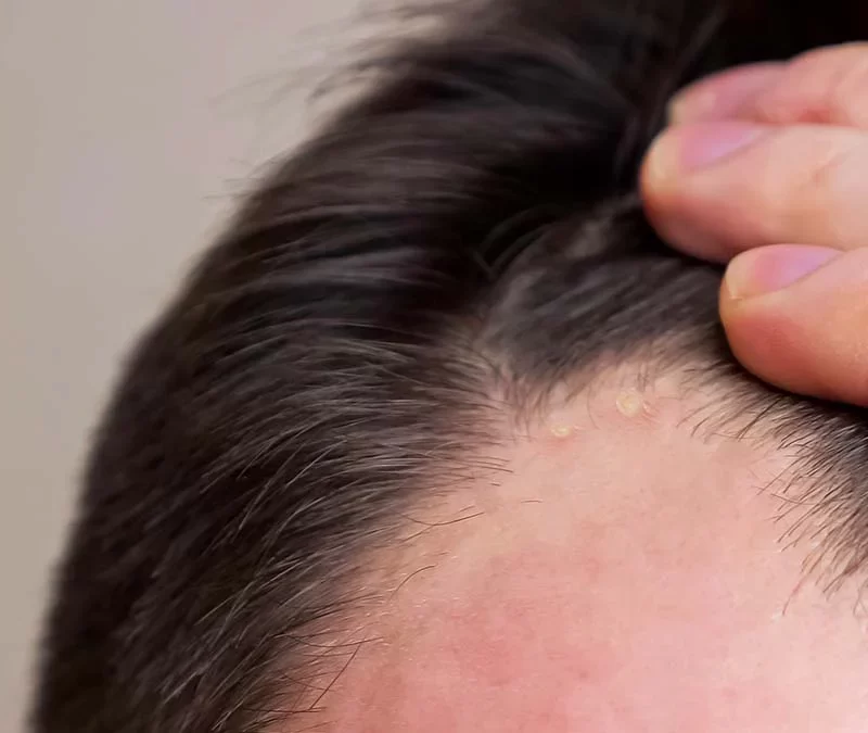 Scalp Acne, Acne