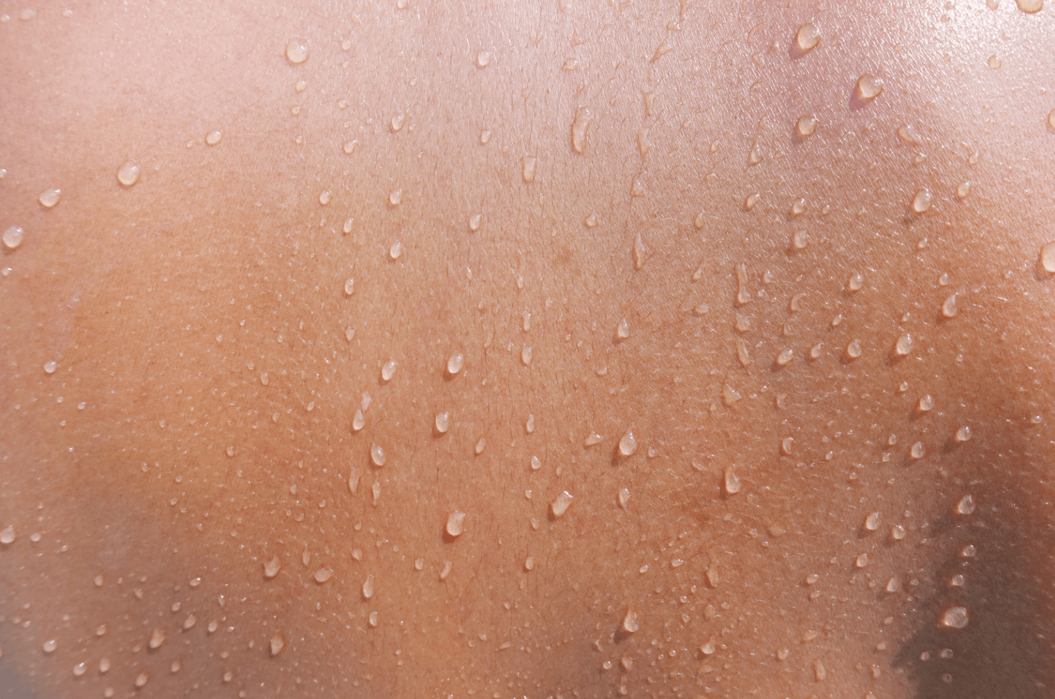 Hyperhidrosis: Meaning, Symptoms, Causes & Treatments