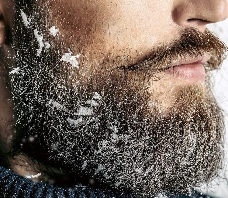 Understanding Beard Dandruff: Causes and Top Treatments