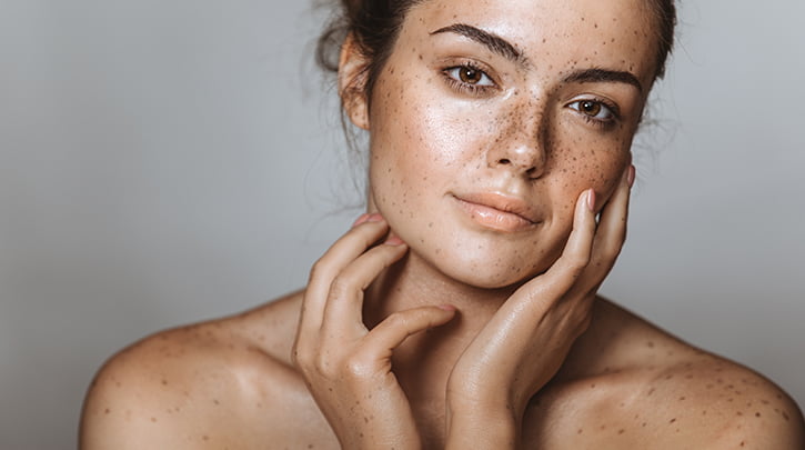 Managing Discoloration: 5 Effective Treatments for Melasma