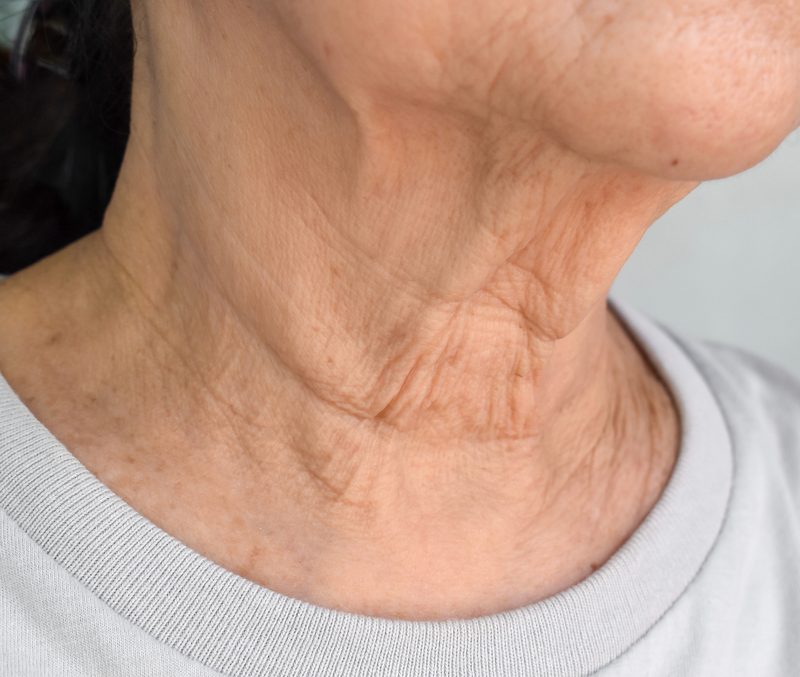 Neck, Wrinkles, neck wrinkles