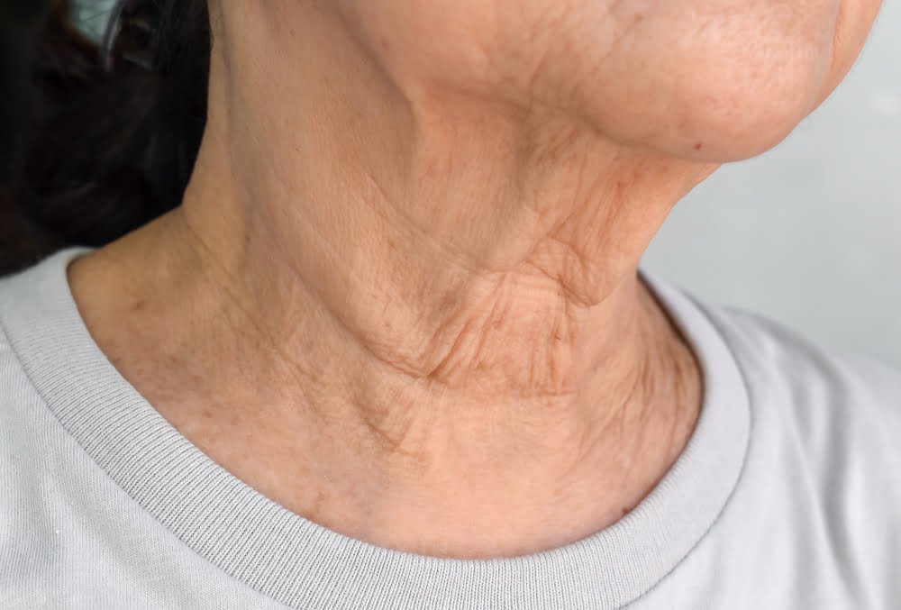 Neck Wrinkles: Causes and Solutions