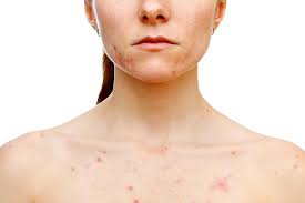 Chest acne, Acne