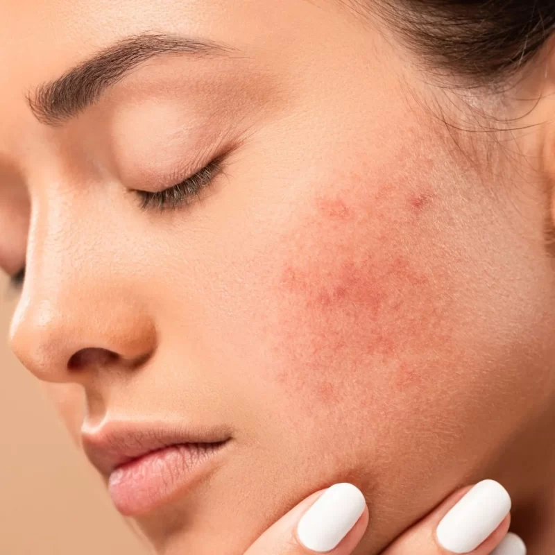hormonal acne