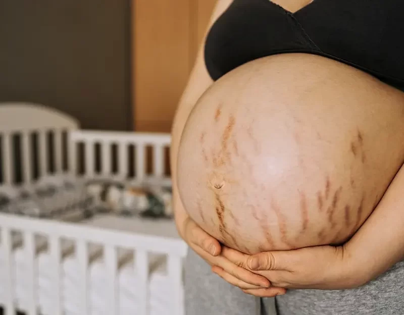 stretch marks, pregnancy