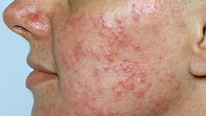 6 Essential Steps for Rosacea Prone Skin: Skincare Guide