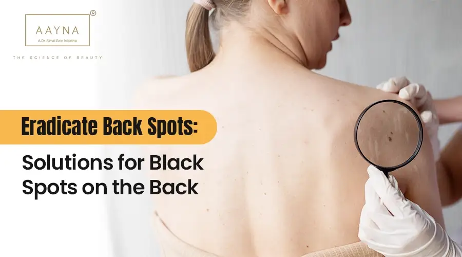 Eradicate Back Spots: Solutions for Black Spots on the Back