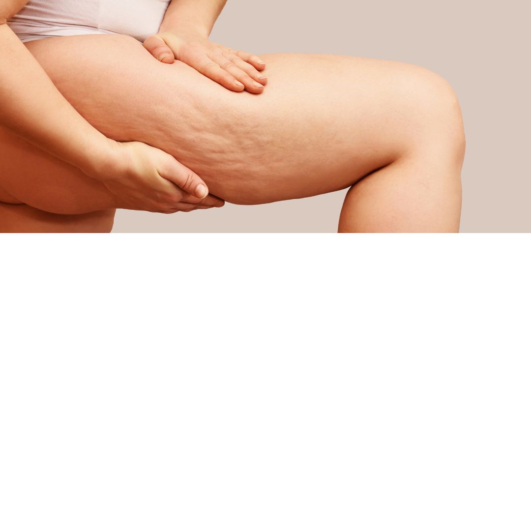 Cellulite 101: Meaning, Causes, Treatments and more